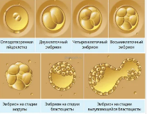 Кумулятивная частота живорождения после ЭКО: динамика во времени, влияние культивирования до стадии блацисты и витрификации